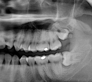 Los Angeles Periodontal Surgeon Wisdom Teeth