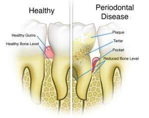 Los Angeles Tooth Decay Periodontal Care