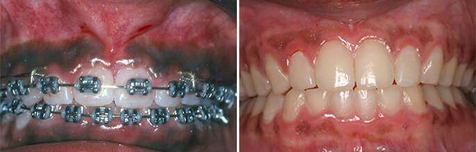 dark spots on gums