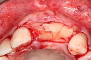 Advanced-platelet-rich-fibrin-aalam4