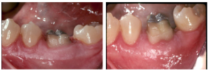 Crown Lengthening for Crowns