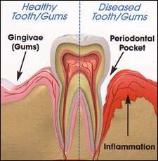 developing gum disease