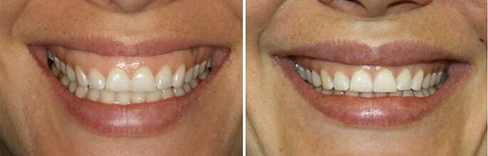 lip-repositioning-before-after gummy smile lip repositioning before and after photo