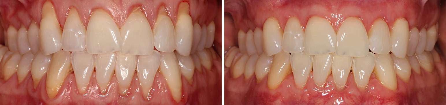 4 Things To Know About Receding Gums Shared By L.A. Periodontists
