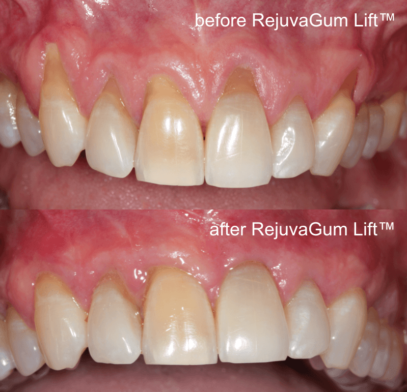 New Receding Gum Treatment Comes To Los Angeles: Uses Healing Power Of Patient’s Blood