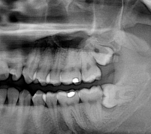 5 Serious Complications from Impacted Wisdom Teeth