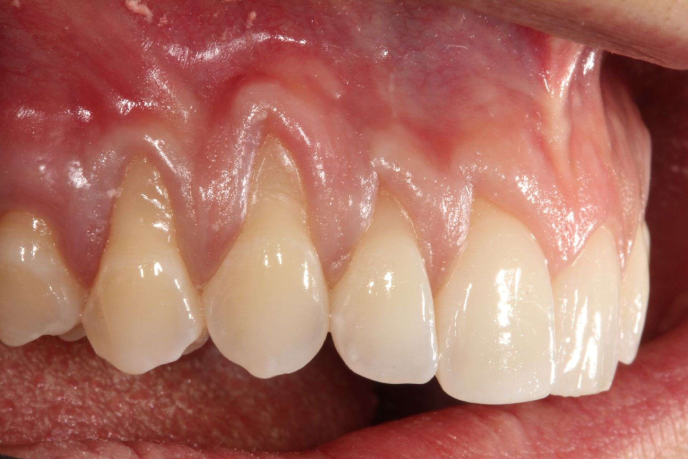 chewing tobacco gums receding Top 8 Ways You're Causing Your Gums to Recede