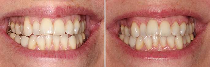 Brentwood Gum Tissue Loss Procedure