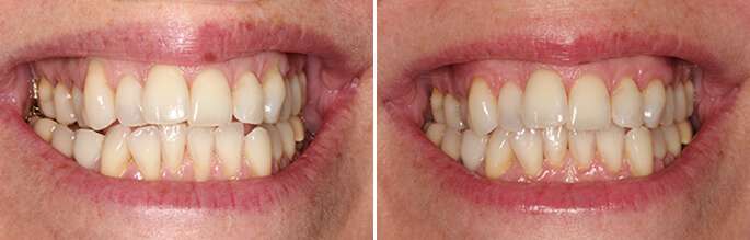 Brentwood Gum Tissue Loss Procedure