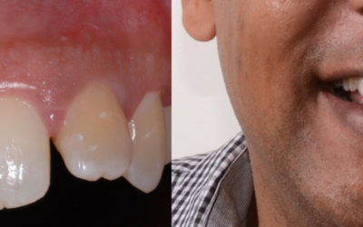 Comparing Immediate Load vs. Traditional Dental Implants