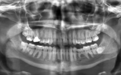 Wisdom Teeth Bothering You? Here’s When You Should Get them Out
