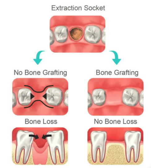 Autogenous dentin grafting