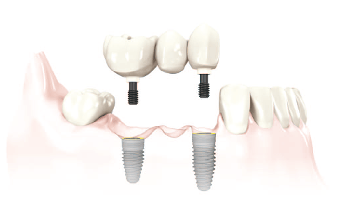 fixed bridge dental implant