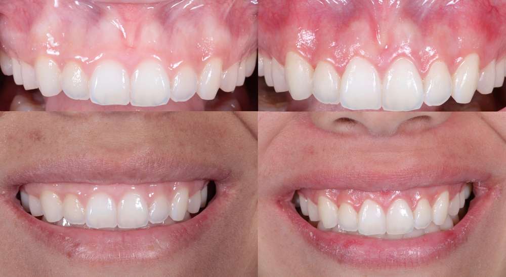 dental crown lengthening los angeles