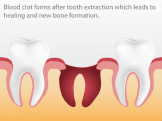 Dry Socket Prevention Los Angeles