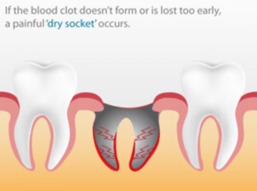 tooth dry socket when blood clot doesn't form