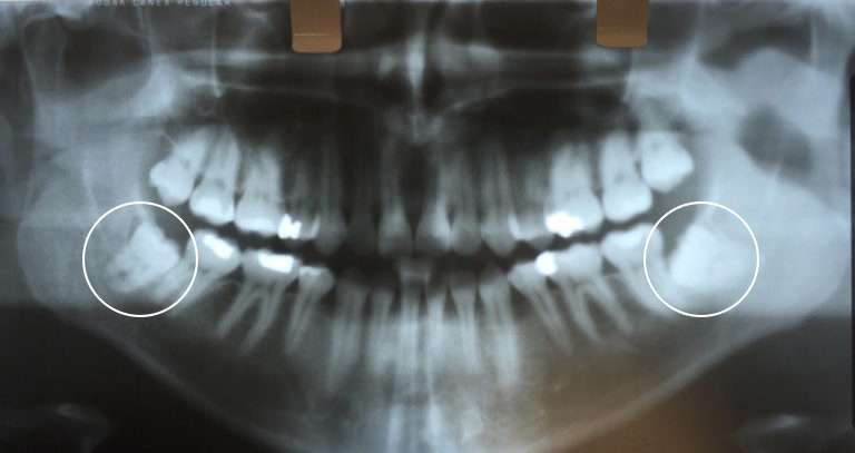 impacted wisdom teeth that need removal