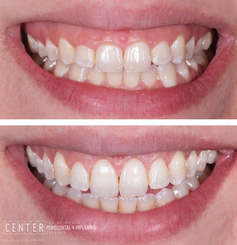 patient close up before and after crown lengthening surgery