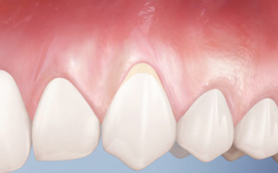 TOOTH ROOT EXPOSURE