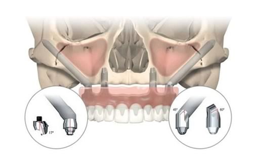 zygomatic implants dental solution