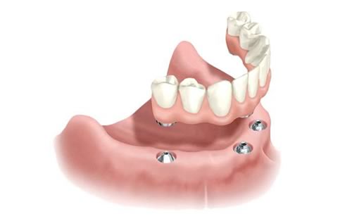 all-on-4 tooth replacement dental implants