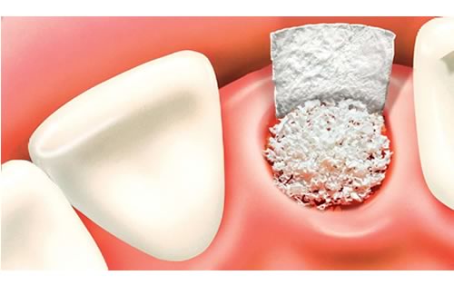 bone graft after tooth extraction