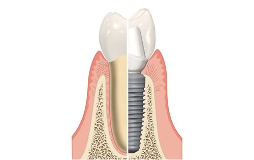 single tooth dental implant