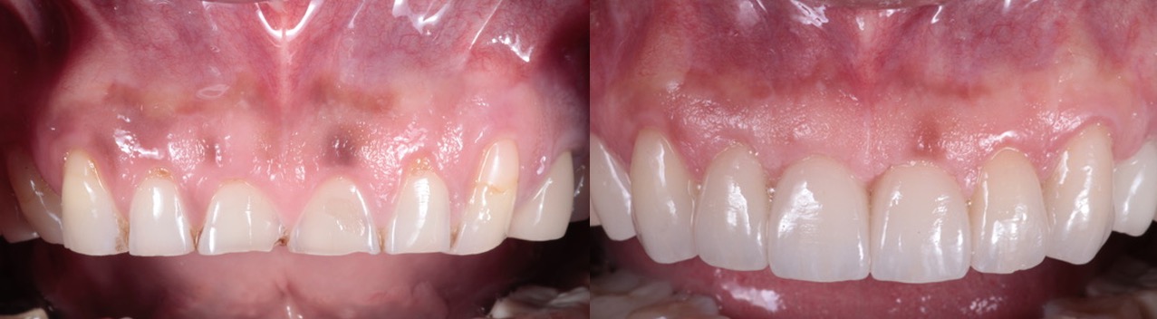 Photo of Cosmetic Gum Depigmentation by Beverly Hills Periodontist Dr. Aalam and Dr. Krivitsky