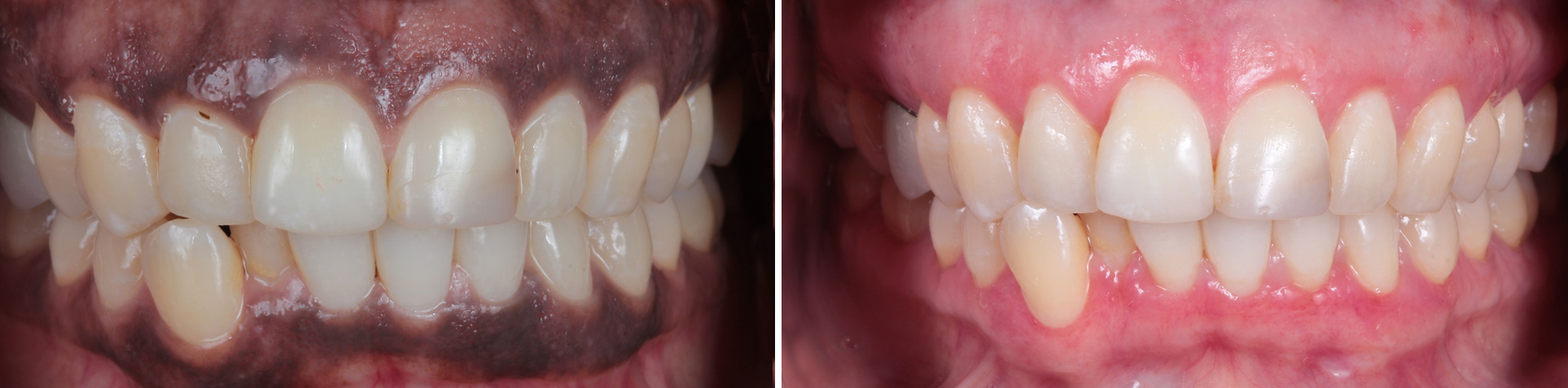 Image of Multiple Dental Implants Before and After by Dr Aalam and Dr Krivitsky at Implant Perio Center Westwood Los Angeles