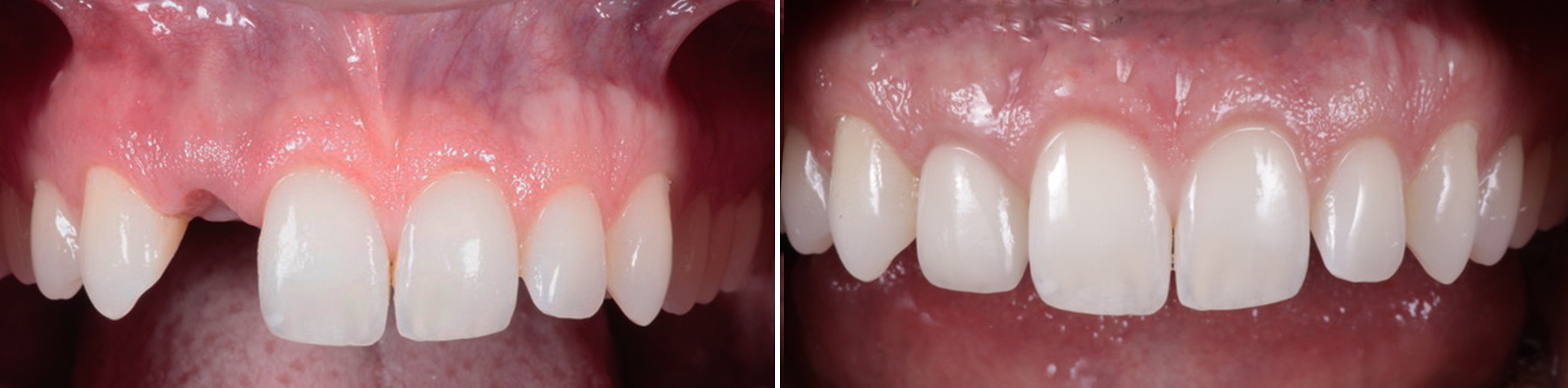 Photo of Cosmetic Gum Depigmentation by Beverly Hills Periodontist Dr. Aalam and Dr. Krivitsky