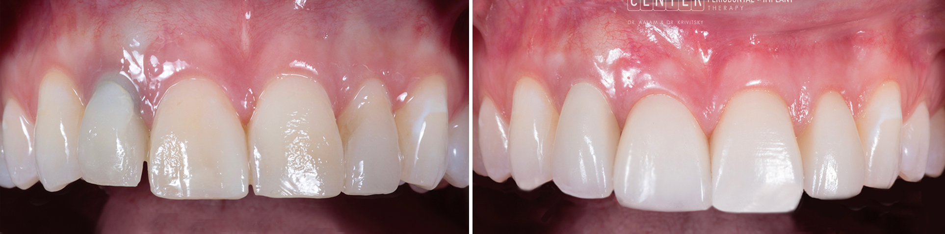 Photo of Cosmetic Gum Depigmentation by Beverly Hills Periodontist Dr. Aalam and Dr. Krivitsky