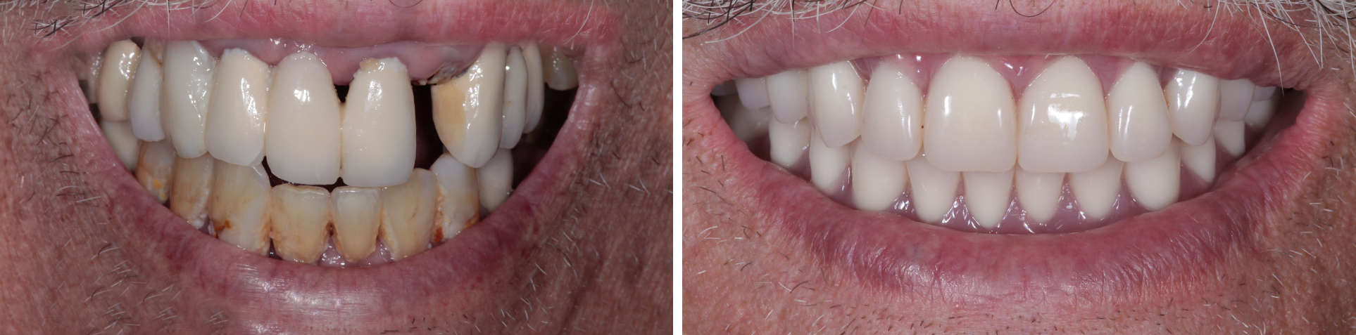 Photo of Cosmetic Gum Depigmentation by Beverly Hills Periodontist Dr. Aalam and Dr. Krivitsky