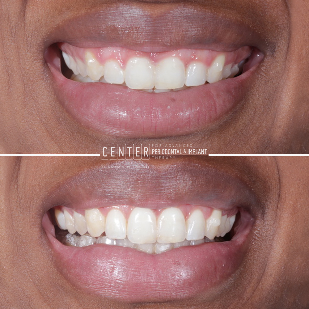 esthetic crown lengthening beverly hills