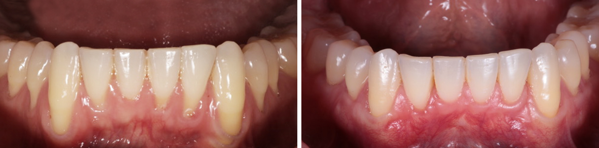 Photo of Cosmetic Gum Depigmentation by Beverly Hills Periodontist Dr. Aalam and Dr. Krivitsky