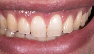 RejuvaGum-Lift-Brentwood-The-Center-Periodontists-After