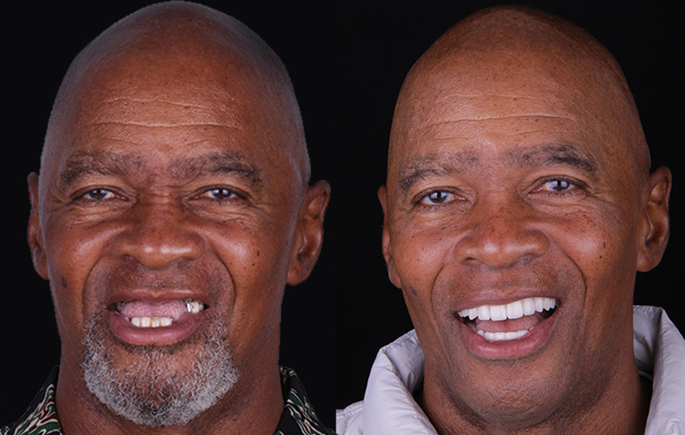 periodontal dental implants patient before and after
