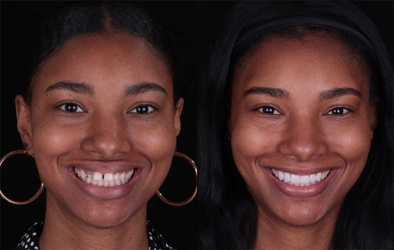 Smile Makeovers Before and After Photos in Los Angeles