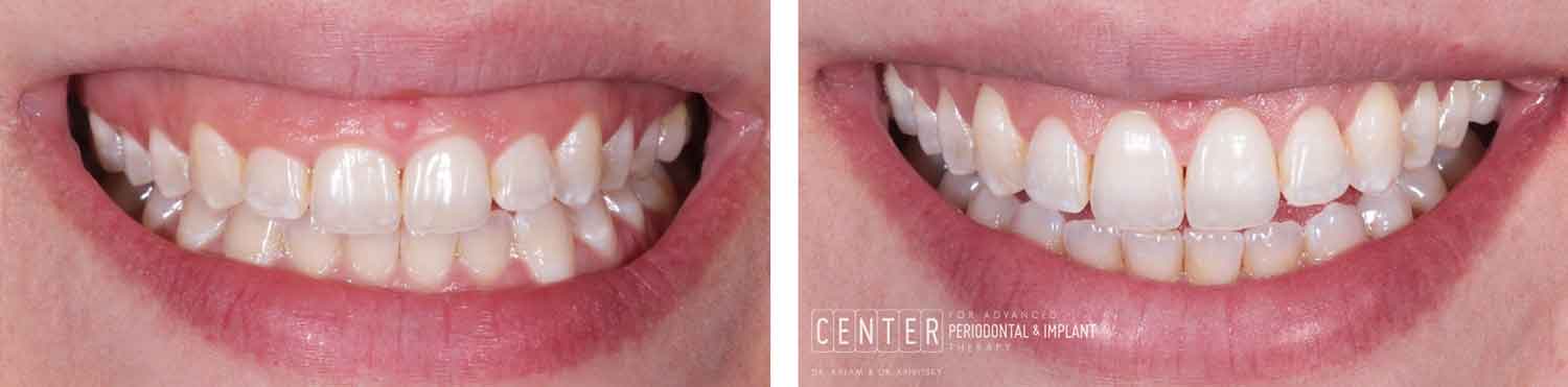  women's smile improves after crown lengthening gummy smile procedure