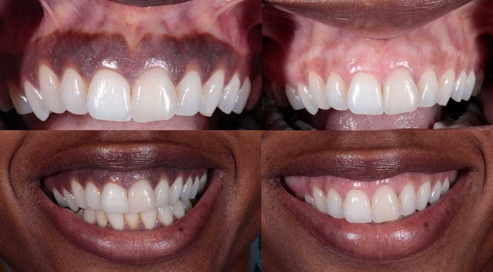 dark gums before and after gum depigmentation