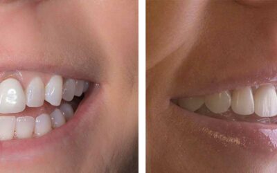 Non-Surgical Lip Repositioning vs. Surgical Repositioning to Fix Gummy Smiles