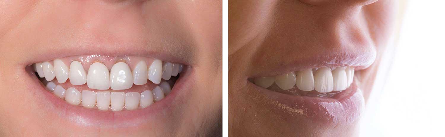 gorgeous before and after smile from a patient in Los Angeles after a gummy smile treatment