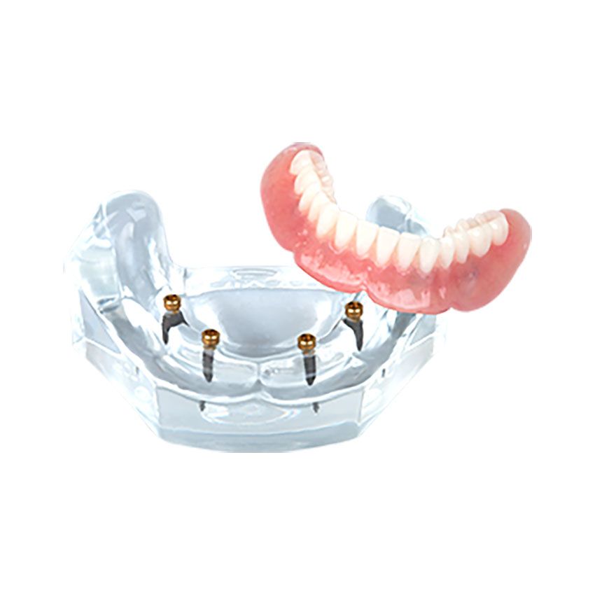 Overdenture model