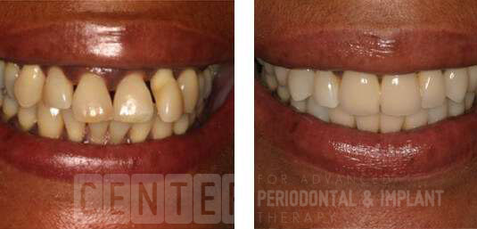 Dental-Implants-Brentwood