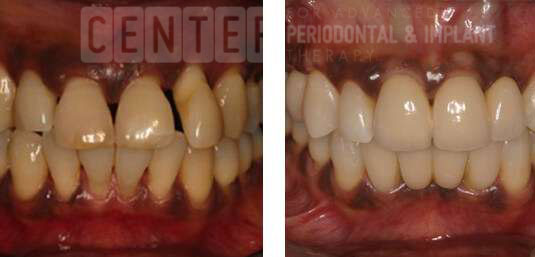 Aalam-Krivitsky-Brentwood-Before-After-Periodontal-Procedures-2-large-535x257