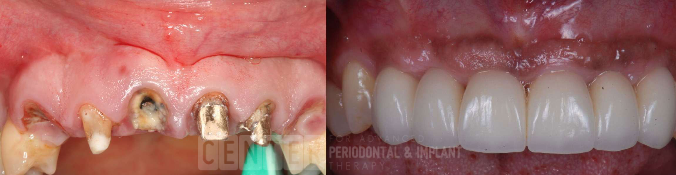 sinus bone graft before after