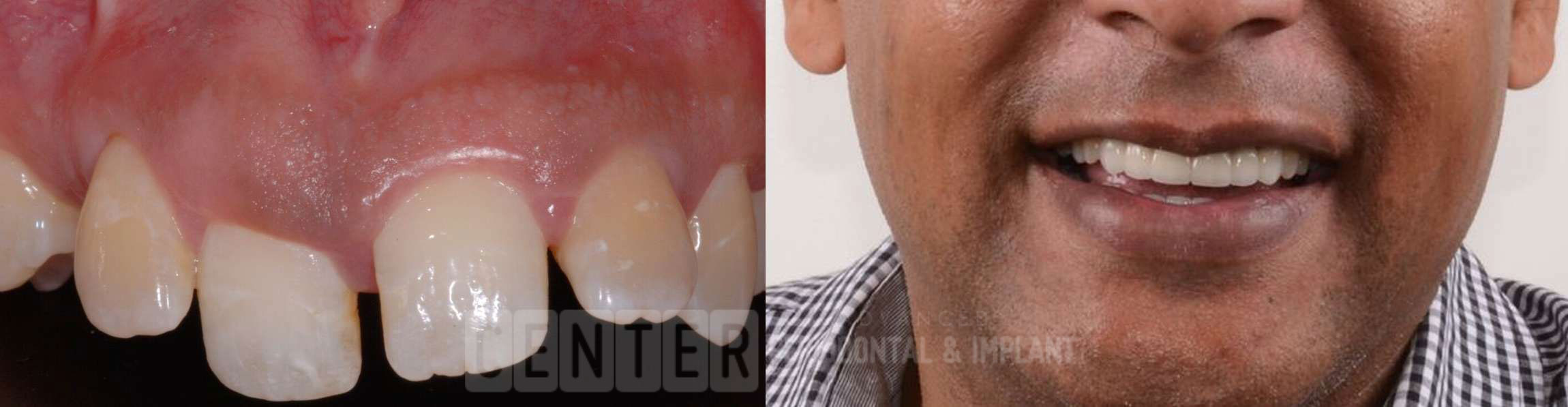 single tooth implant before after