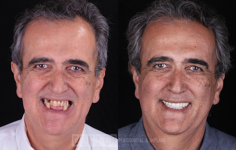 tooth implant before after