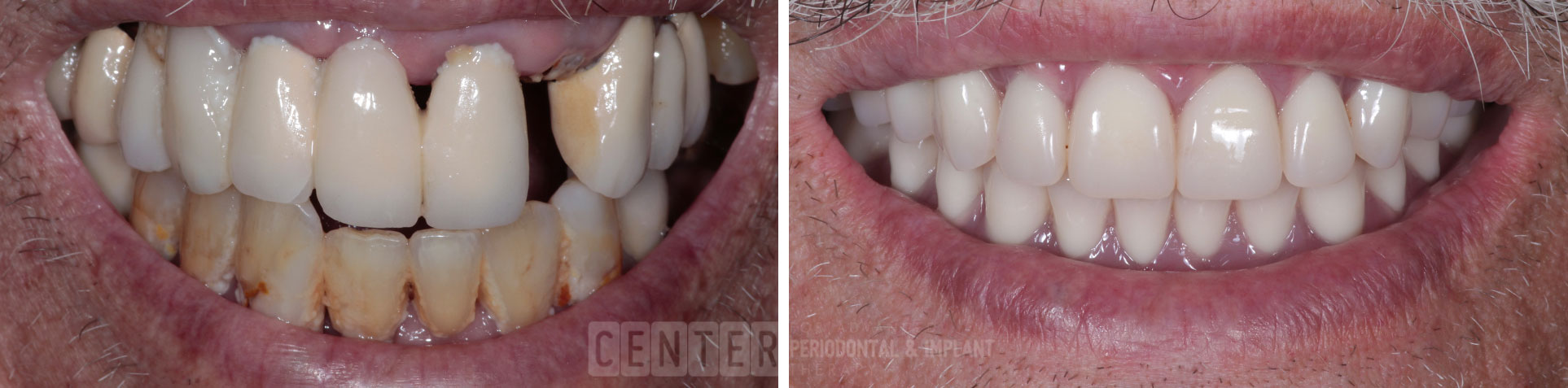 single tooth implant before after