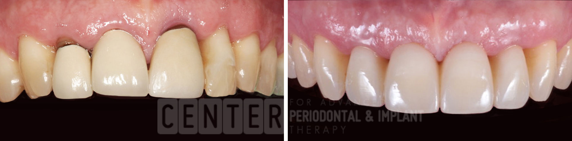 sinus bone graft before after