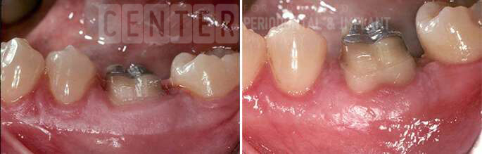 periodontist-los-angeles-functional-crown-lengthening-2
